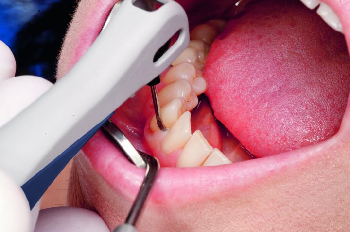 ΣΥΣΤΗΜΑ ΠΕΡΙΟΔΟΝΤΙΚΗΣ ΘΕΡΑΠΕΙΑΣ VECTOR PARO PRO ΤΗΣ DURR