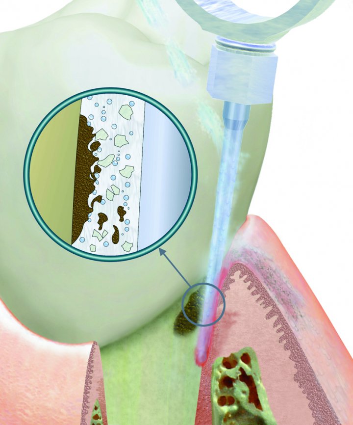 ΣΥΣΤΗΜΑ ΠΕΡΙΟΔΟΝΤΙΚΗΣ ΘΕΡΑΠΕΙΑΣ VECTOR PARO PRO ΤΗΣ DURR
