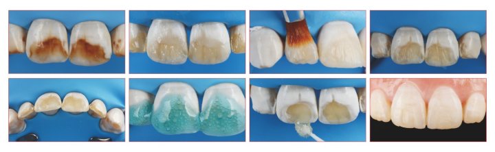 ΝΑΝΟΚΕΡΑΜΙΚΗ ΣΥΝΘΕΤΗ ΡΗΤΙΝΗ ZENIT